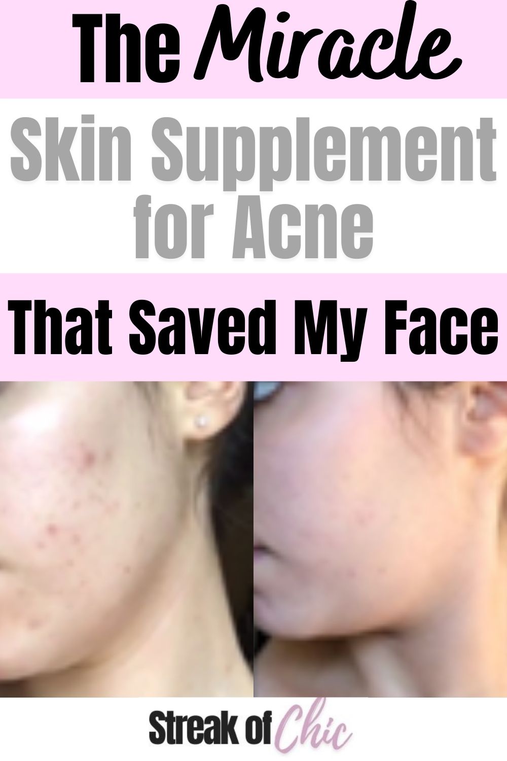 The Best Skin Supplement for Acne that Saved My Face
